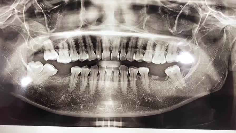 Cấy ghép implant khôi phục răng 46 bị mất cho khách hàng tại Nha Khoa Thùy Anh.